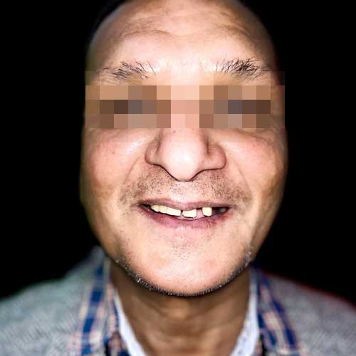 Patient photo before All-on-six dental implant Full Mouth Rehabilitation