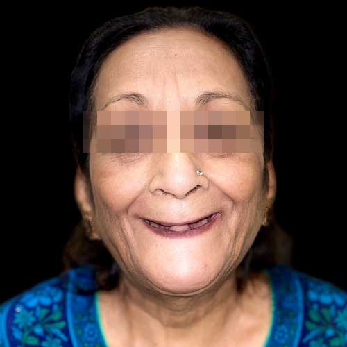 Patient photo before Full mouth rehabilitation