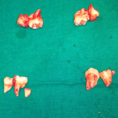 wisdom teeth removed