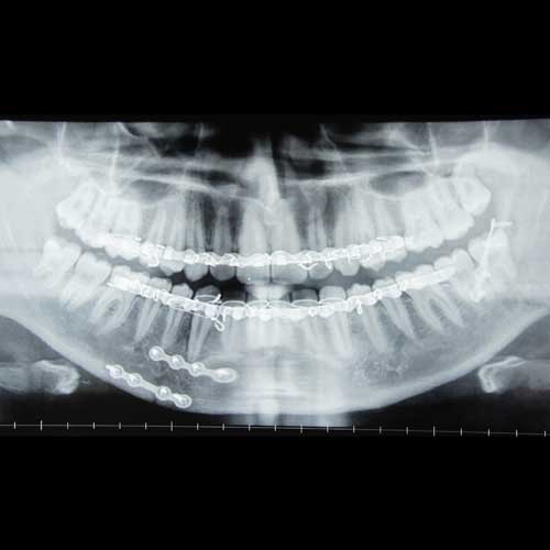 LOWER JAW FRACTURE SURGERY