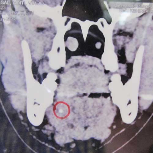 PRE-OP OPG SHOWS SIALOLITH