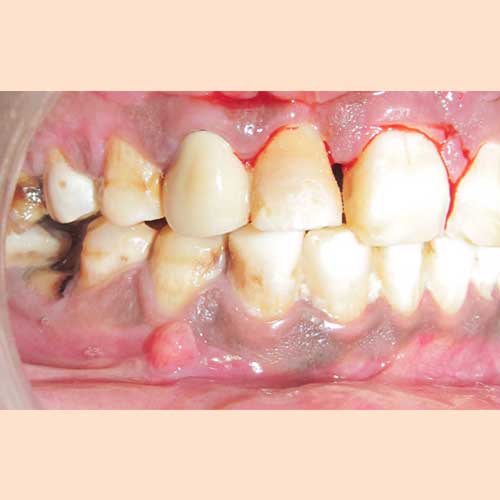 ZYGOMA FRACTURE POST-OP