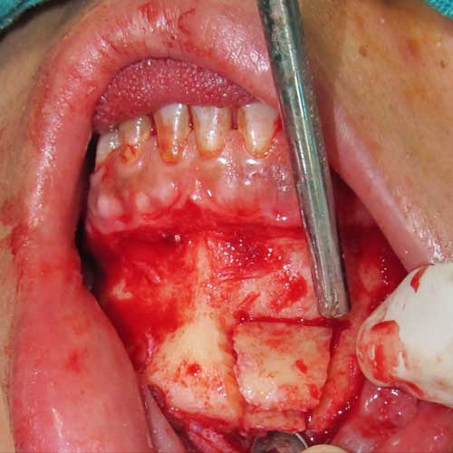tumour excision surgery