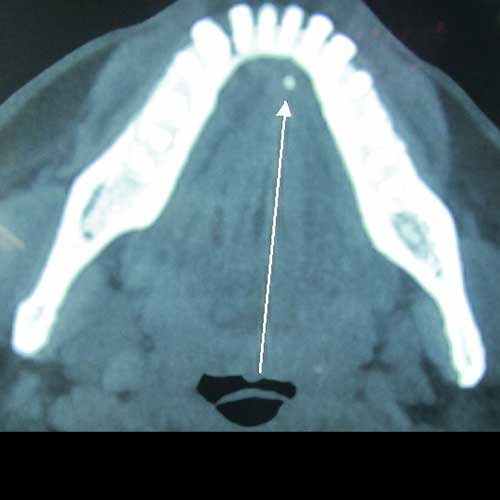 Sialolithotomy