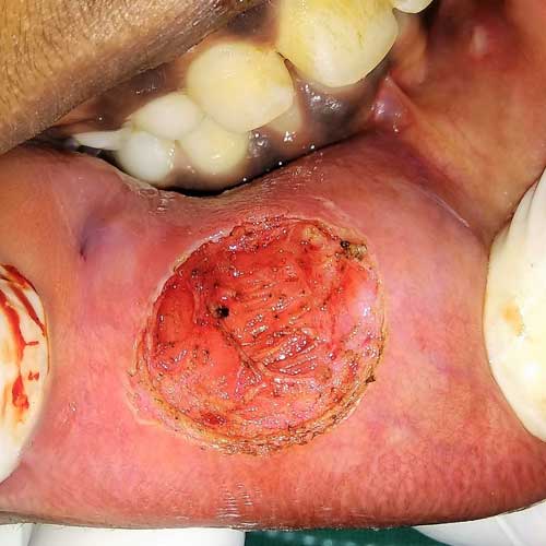 MUCOCELE REMOVED