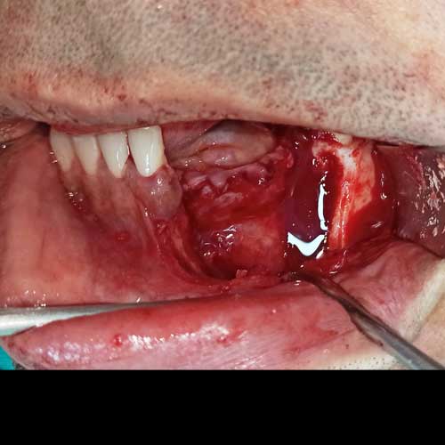 Ameloblastoma Tumour Surgery