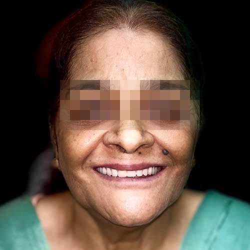 Patient Photo After Implant Retained Prosthesis