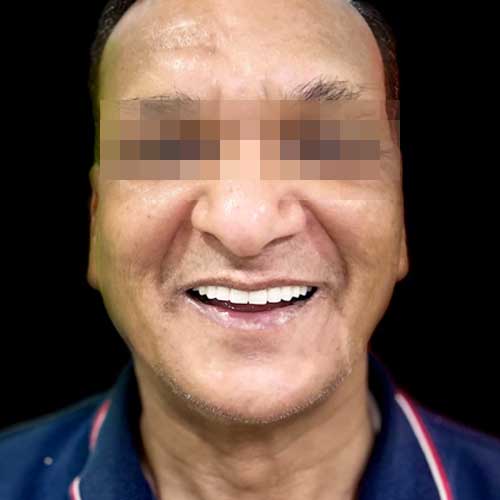 Patient photo after All-on-six dental implant Full Mouth Rehabilitation