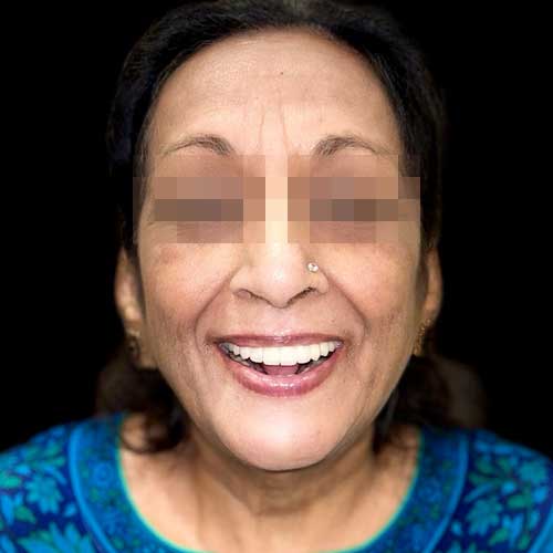 Patient photo After Full mouth rehabilitation using dental implant