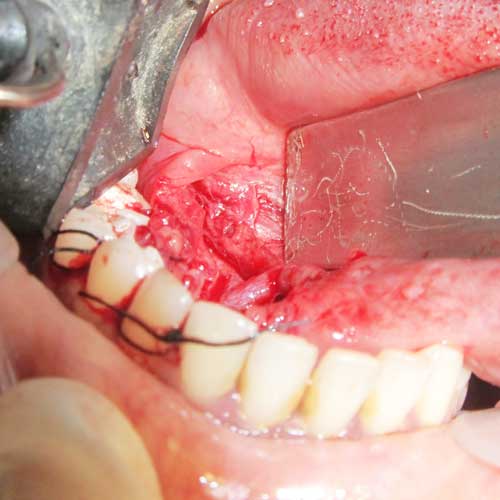 SIALOLITH REMOVAL SURGERY