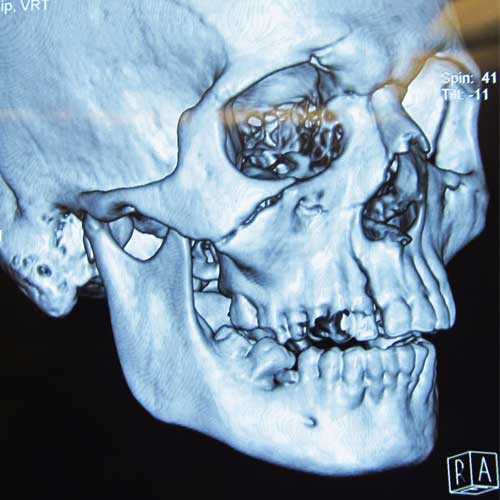 ZYGOMA FRACTURE PRE-OP