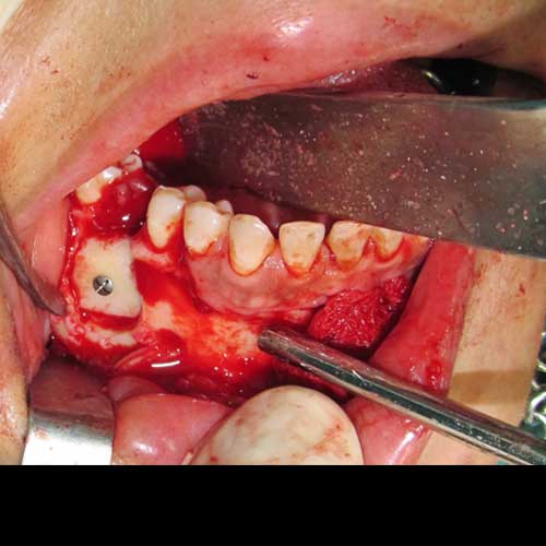 CHIN GRAFT PLACED OVER THE TUMOUR EXCISION SITE