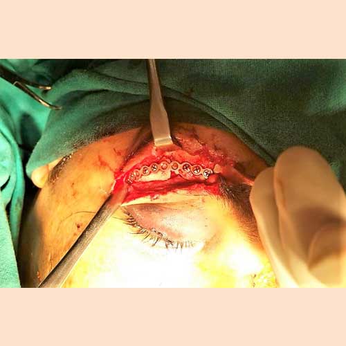 ORBITAL FRACTURE FIXATION