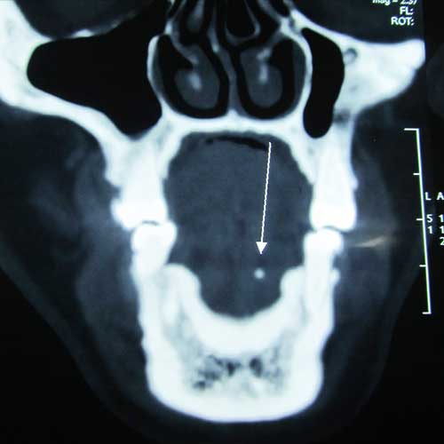Sialolithotomy