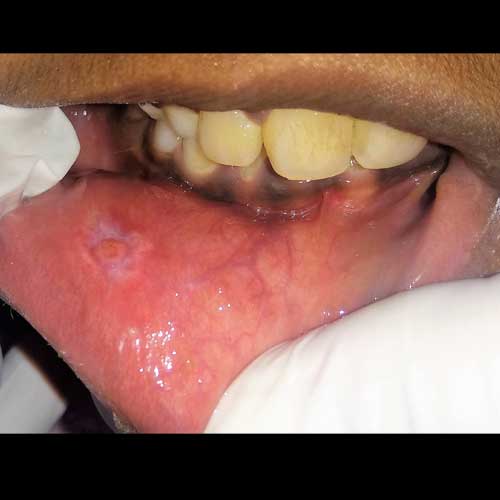 mucocele removal surgery