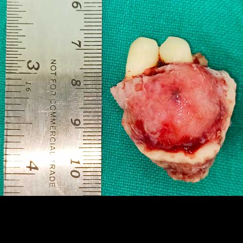ameloblastoma tumor