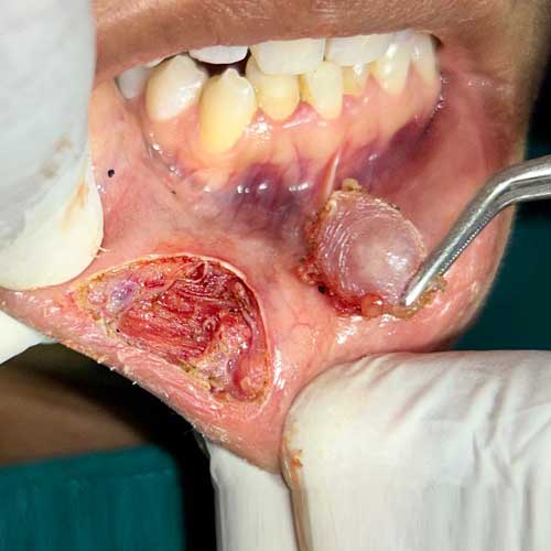 Salivary Pseudocyst (Mucocele) Excision