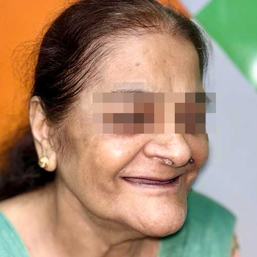 Patient Photo Before Implant Retained Prosthesis