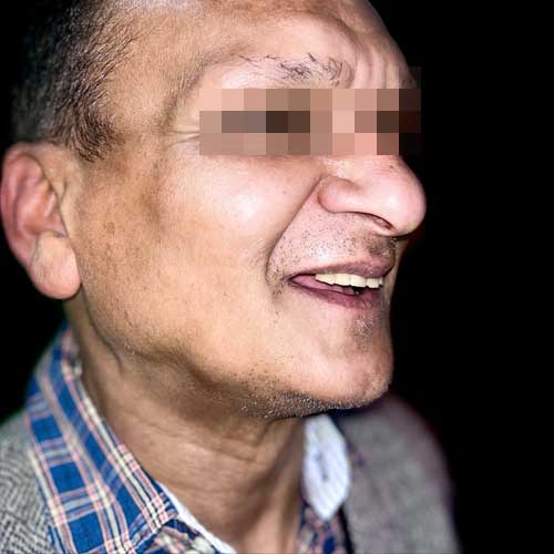 Patient photo before All-on-six dental implant Full Mouth Rehabilitation