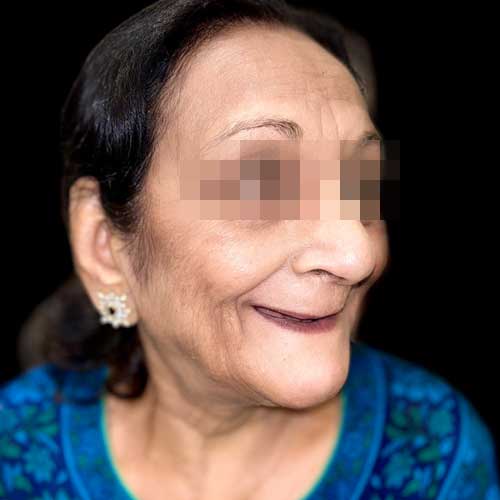 Patient photo before Full mouth rehabilitation