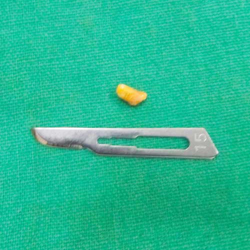 SIALOLITH REMOVED