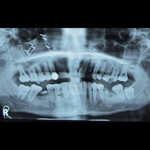 ZYGOMA FRACTURE POST-OP