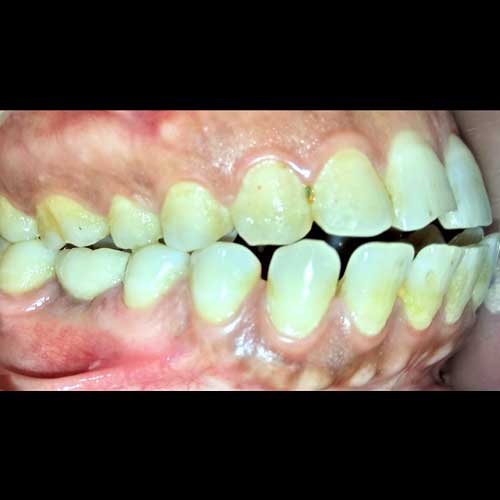 IMPLANT AND CROWN PLACED