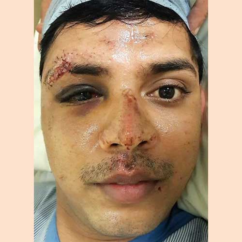 ORBITAL FRACTURE