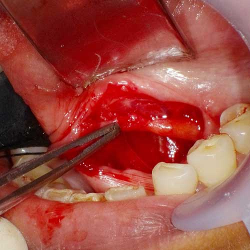 Sialolithotomy