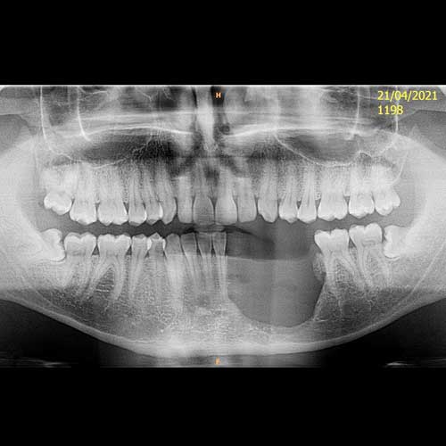 OPG Ameloblastoma Tumor Post-OP