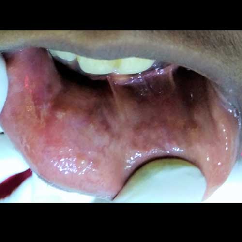 mucocele removal surgery