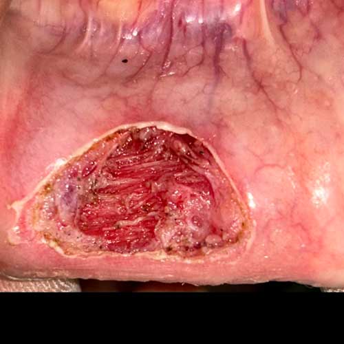 Mucocele Removed