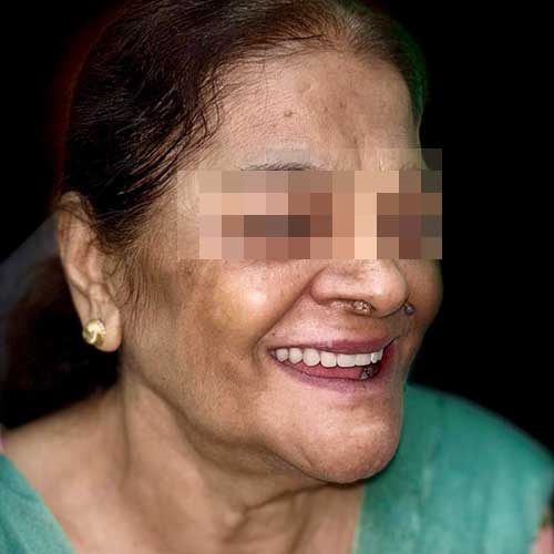 Patient Photo After Implant Retained Prosthesis