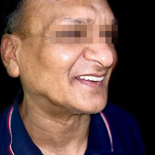 Patient photo after All-on-six dental implant Full Mouth Rehabilitation