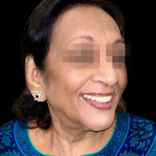Patient photo After Full mouth rehabilitation using dental implant