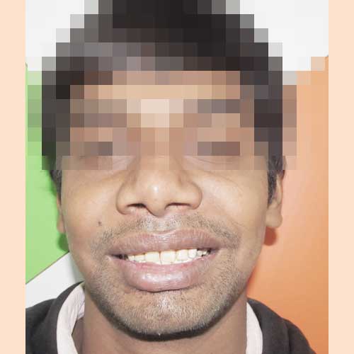 ZYGOMA FRACTURE POST-OP