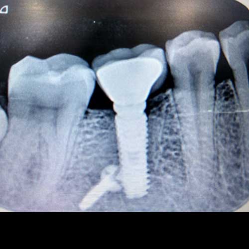 RADIOGRAPH SHOWING IMPLANT AND CROWN
