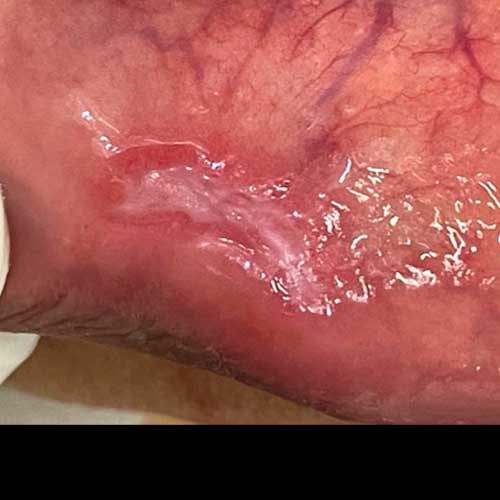 Recovery After Mucocele Excision Surgery