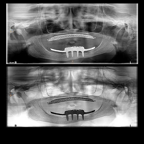 OPG Implant Retained Prosthesis