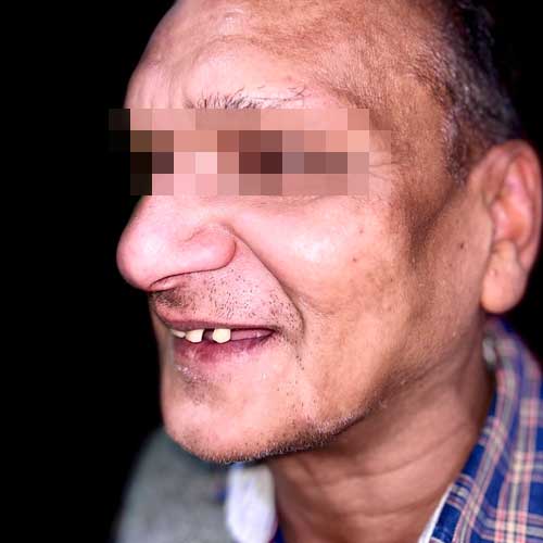 Patient photo before All-on-six dental implant Full Mouth Rehabilitation