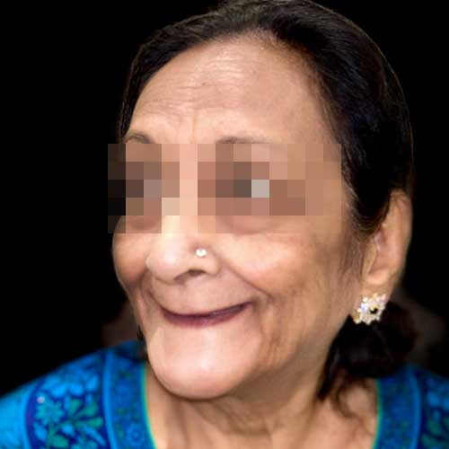 Patient photo before Full mouth rehabilitation