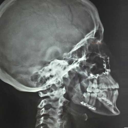 ORTHOGNATHIC SURGERY