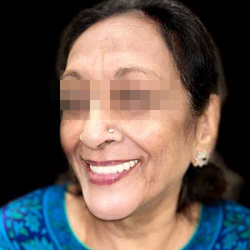 Patient photo After Full mouth rehabilitation using dental implant