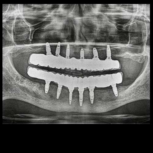 OPG All-on-six dental implant Full Mouth Rehabilitation