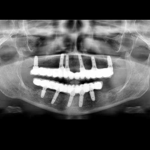 OPG shows Full mouth rehabilitation using dental implant