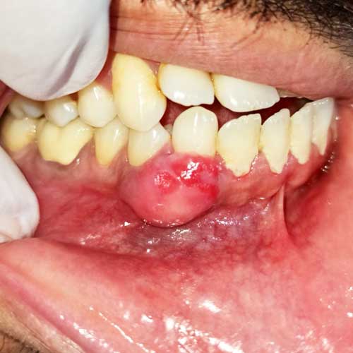 Peripheral Granuloma removal with Laser
