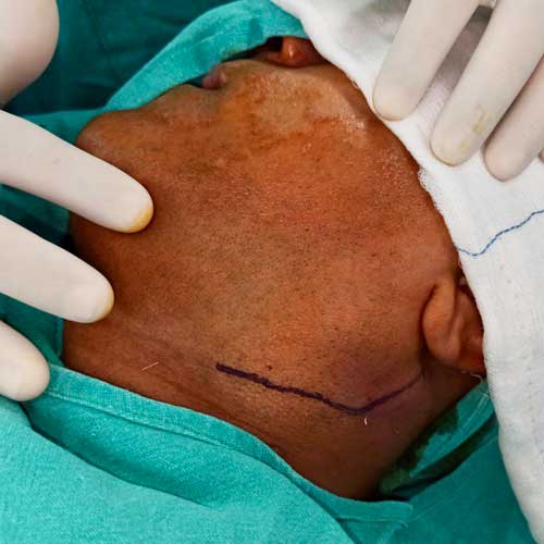 Massive Lipoma removal from Neck