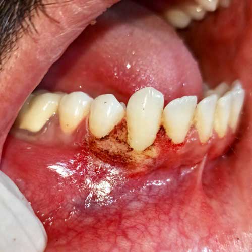 Peripheral Granuloma removal with Laser