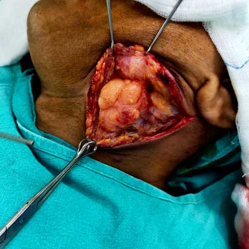 Massive Lipoma removal from Neck