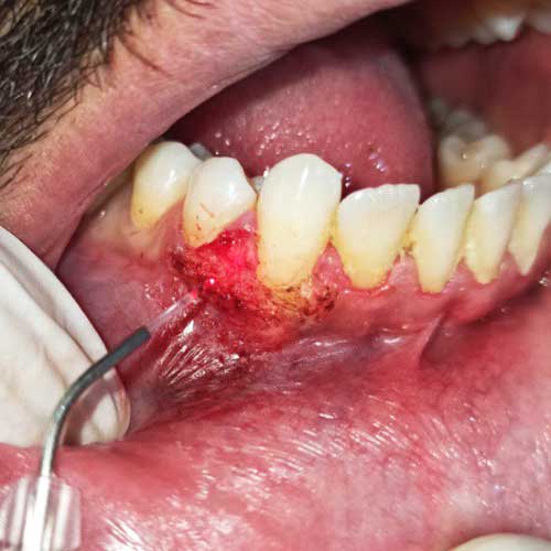 Peripheral Granuloma removal with Laser